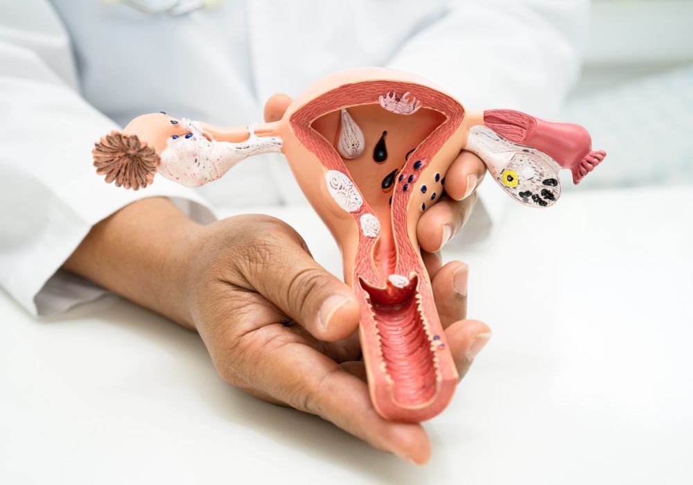 Natural Solutions for PCOD/PCOS: How Unani Medicine Can Help