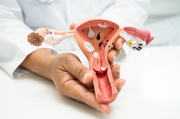 Natural Solutions for PCOD/PCOS: How Unani Medicine Can Help