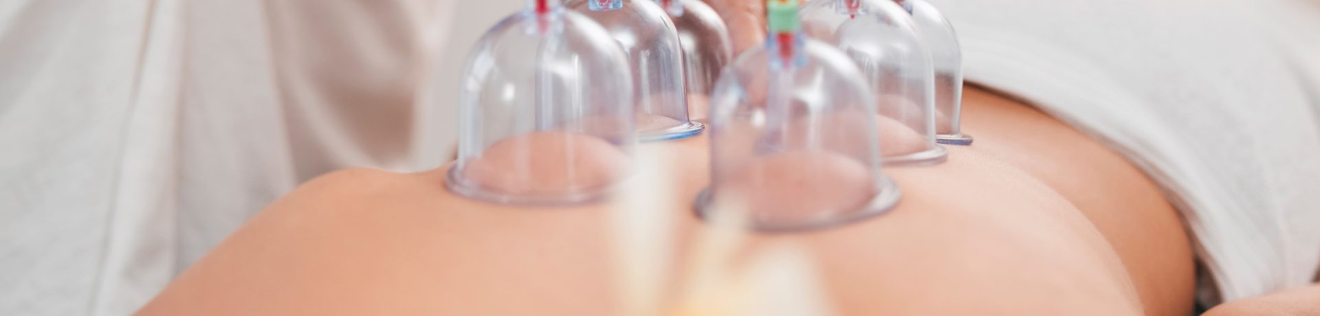 Hijama (Cupping Therapy) : Benefits and Why You Should Try It