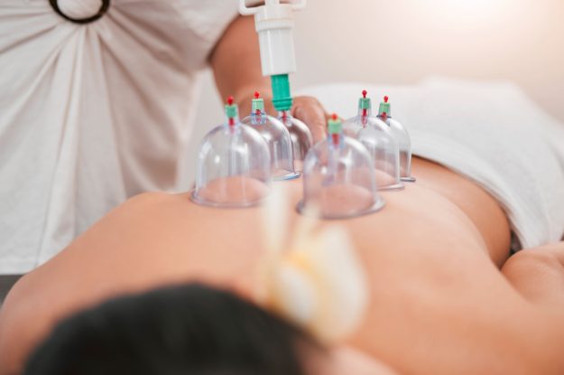 Hijama (Cupping Therapy) : Benefits and Why You Should Try It